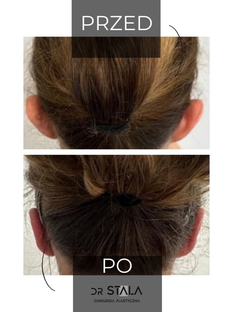 Maciej Stala Efekty przed i po (1)