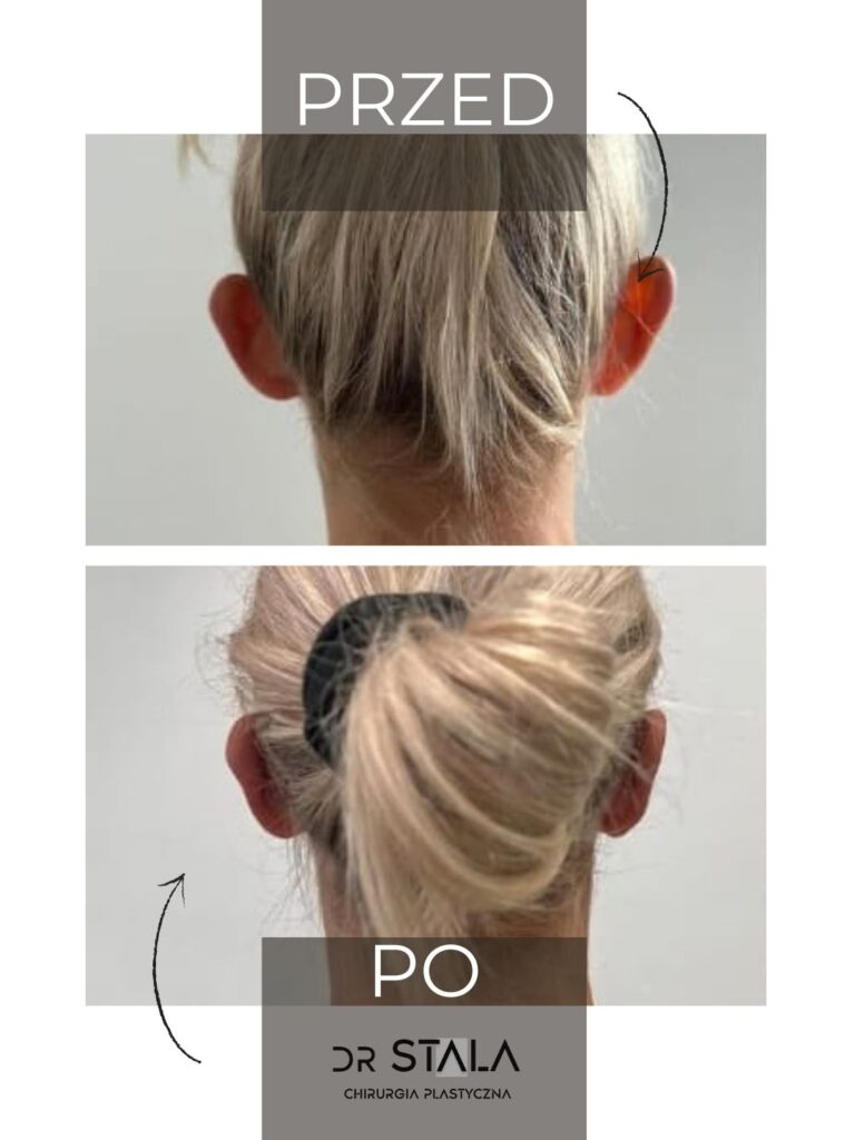 Maciej Stala Efekty przed i po (15)