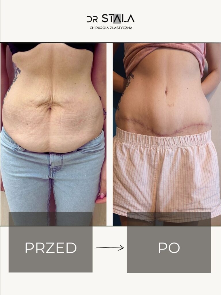 Maciej Stala Efekty przed i po (3)