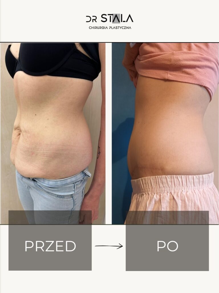 Maciej Stala Efekty przed i po (4)