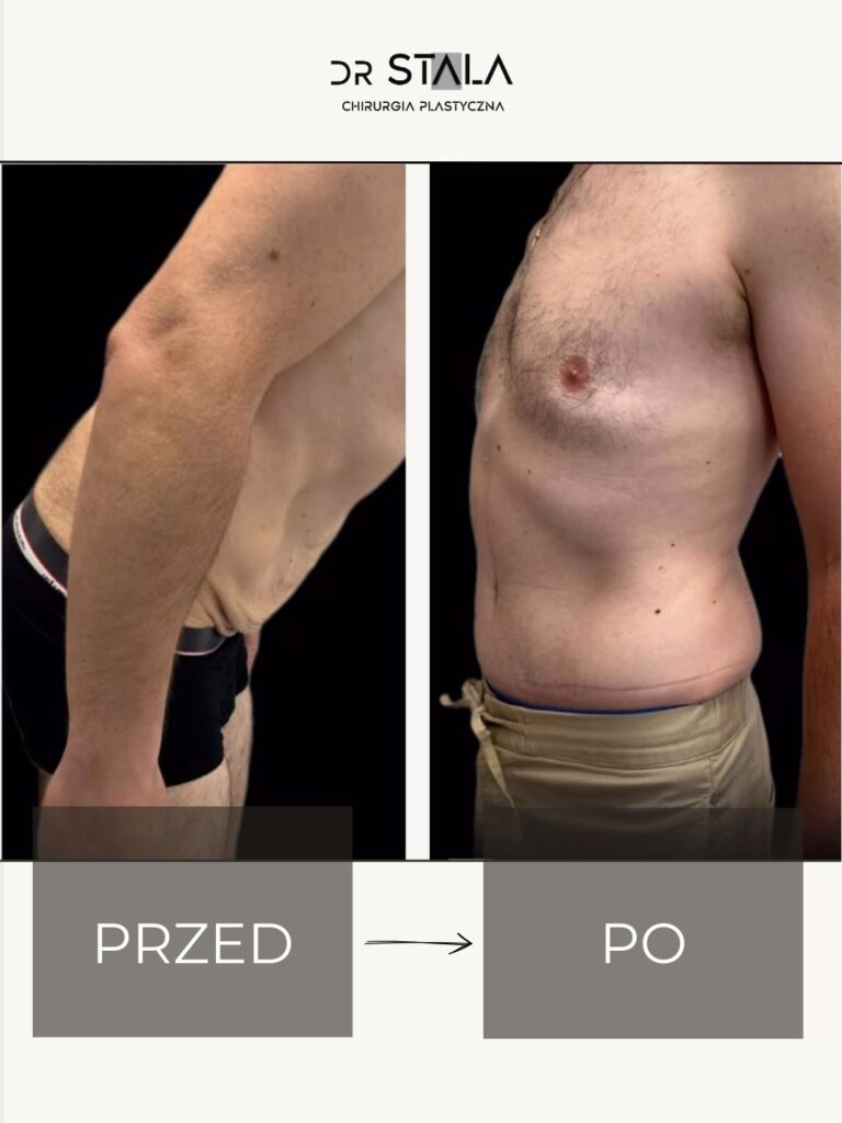 Maciej Stala Efekty przed i po (5)