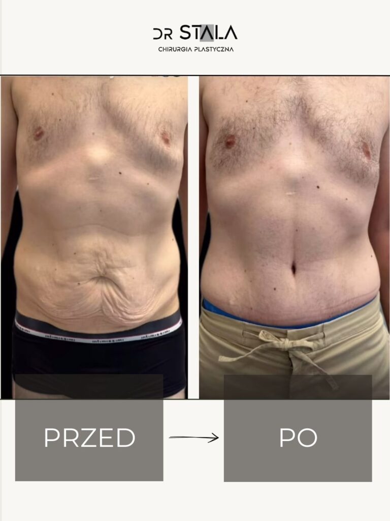 Maciej Stala Efekty przed i po (6)